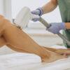 LASER HAIR REMOVAL IN LONDON